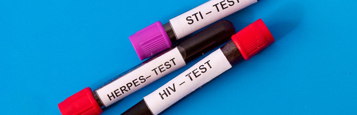 three tubes of blood for testing for sexually transmitted diseases isolated on a blue background. testing for HIV, herpes, sti.