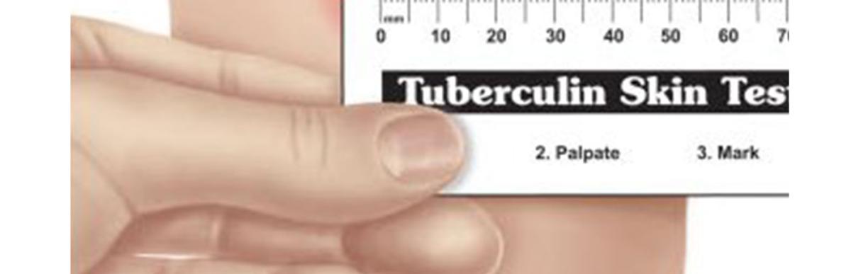 Illustration of person measuring tuberculin test of skin