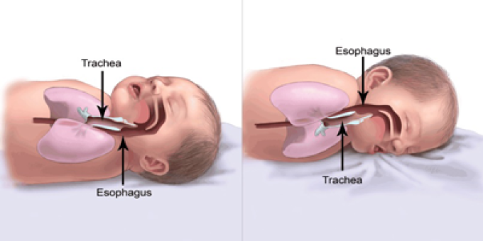 Diagram of baby's airway when sleeping on their back vs. stomach